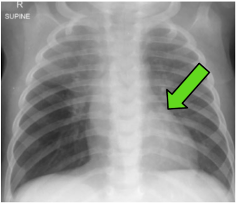 Radiografia de tórax com seta sobre a borda lateral esquerda da silhueta cardíaca.