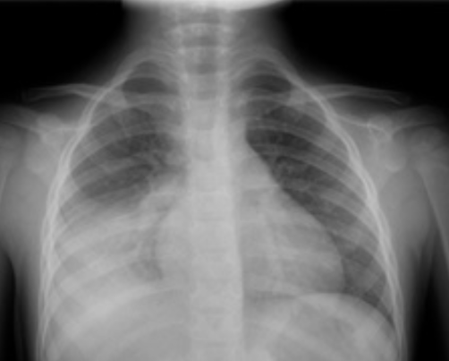 Radiografia frontal do tórax com alteração pleural basal unilateral a localizar.