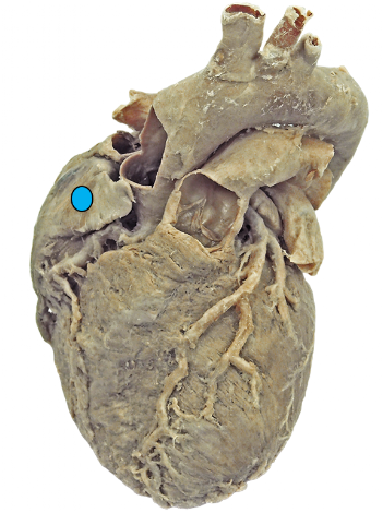Peça anatômica do coração em vista anterior, com círculo azul sobre um apêndice atrial.