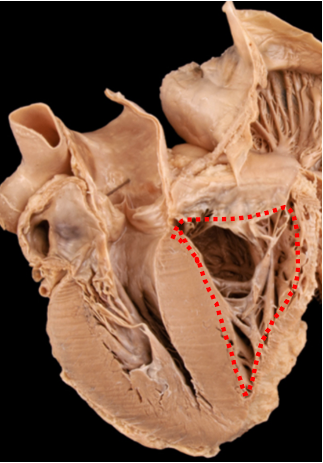 Peça cardíaca aberta, com tracejado vermelho delimitando uma cavidade ventricular.