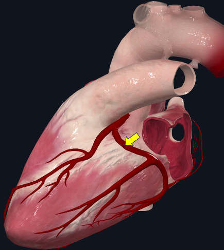 Modelo cardíaco em vista oblíqua, com seta amarela sobre um vaso no sulco atrioventricular.