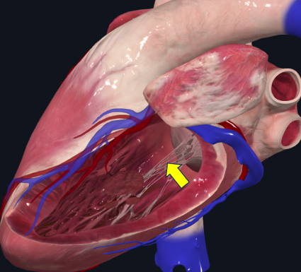 Modelo de ventrículo aberto, com seta amarela sobre estruturas fibrosas finas ligadas à valva.