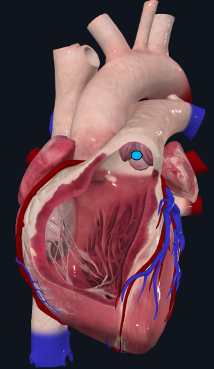 Modelo cardíaco anterior aberto, com círculo azul sobre uma valva na via de saída ventricular.