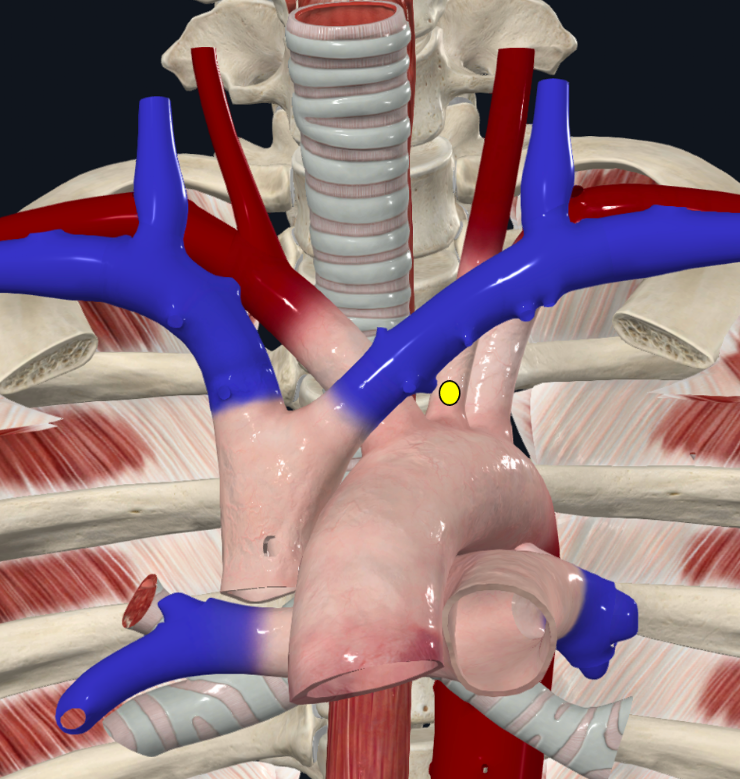Modelo dos grandes vasos, com círculo amarelo sobre um ramo do arco da aorta.