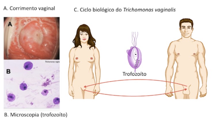Composição clínica e microscópica de infecção urogenital por Trichomonas vaginalis, acompanhada de esquema de transmissão.