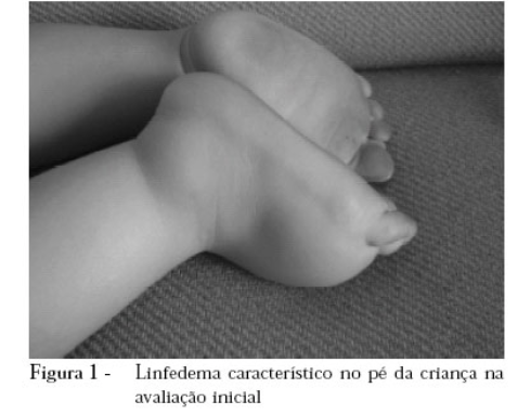 Fotografia clínica de pé infantil com edema compatível com linfedema congênito.