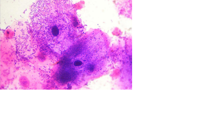 Micrografia de esfregaço vaginal com células epiteliais recobertas por bactérias, compatíveis com células-guia.