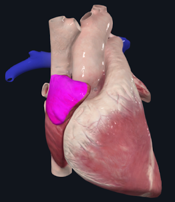 Modelo cardíaco em vista anterior, com apêndice atrial destacado em magenta.