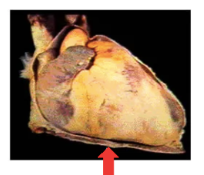 Fotografia anatômica da superfície externa do coração, com seta sobre o revestimento superficial.