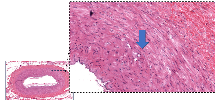 Micrografia de vaso de parede espessa, com seta na camada muscular intermediária.