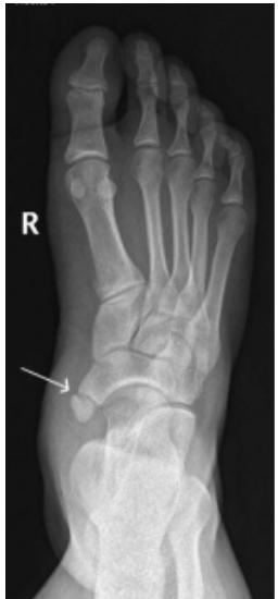 Radiografia do pé direito com seta em ossificação cortificada medial ao navicular.
