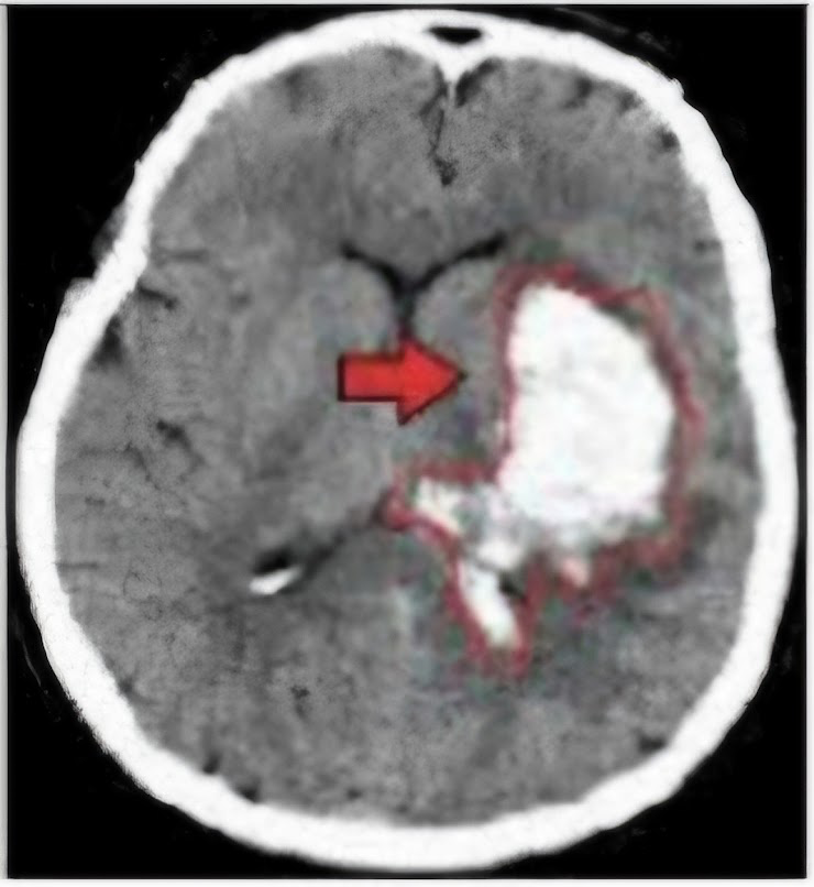 Tomografia axial de crânio com hemorragia intraparenquimatosa profunda e efeito de massa