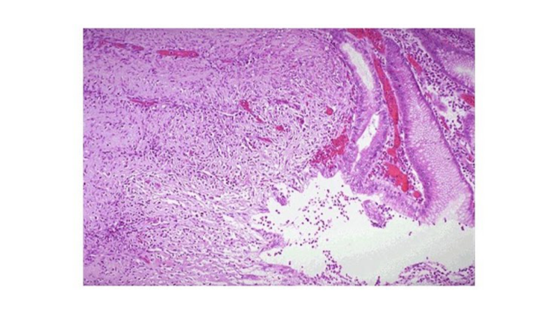 Fotomicrografia da lesão gástrica biopsiada apresentada na questão 3.